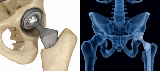 Photo: Hip Replacement With An Anterior Approach