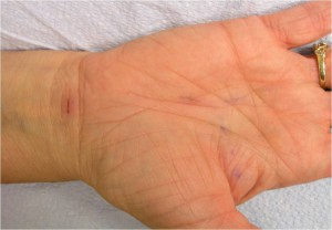 Photo: Carpal Tunnel Syndrome